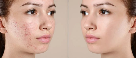 Escaping the Nasty Pimples: Your Ultimate Guide to Clear Skin