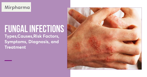 Fungal Skin Care Guide | Symptoms, Treatment & Relief – Mirpharma