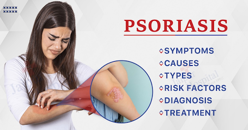 Understanding Psoriasis: Causes, Symptoms, and Effective Treatment Methods