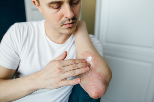 Understanding Eczema: Causes, Prevention, and Effective Treatments for Better Skin Health