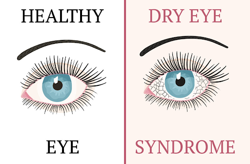 Understanding and Managing Dry Eye Syndrome: Symptoms, Prevention, and Treatment Options